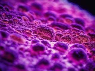 Paola Marella e il tumore al pancreas: guida all'adenocarcinoma e alle metastasi