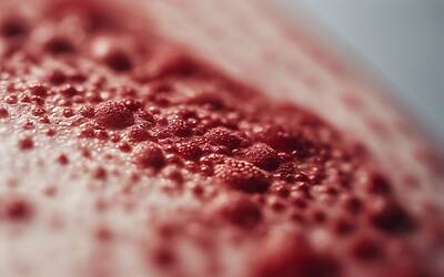 Psoriasi: Scopri le Cause, i Rimedi e le Ultime Novità per la Cura