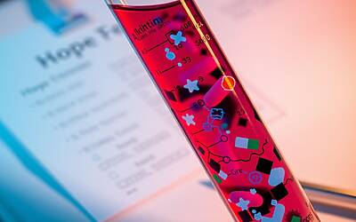 Alzheimer prevenzione efficace e test del sangue innovativi per diagnosi precoce e miglior gestione della malattia